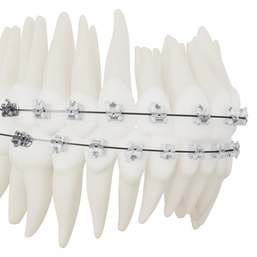 Translucent Self-Ligating Braces in Salmon Arm