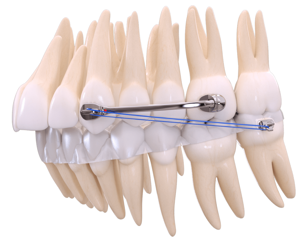 Smile Bars at Shuswap Orthodontics